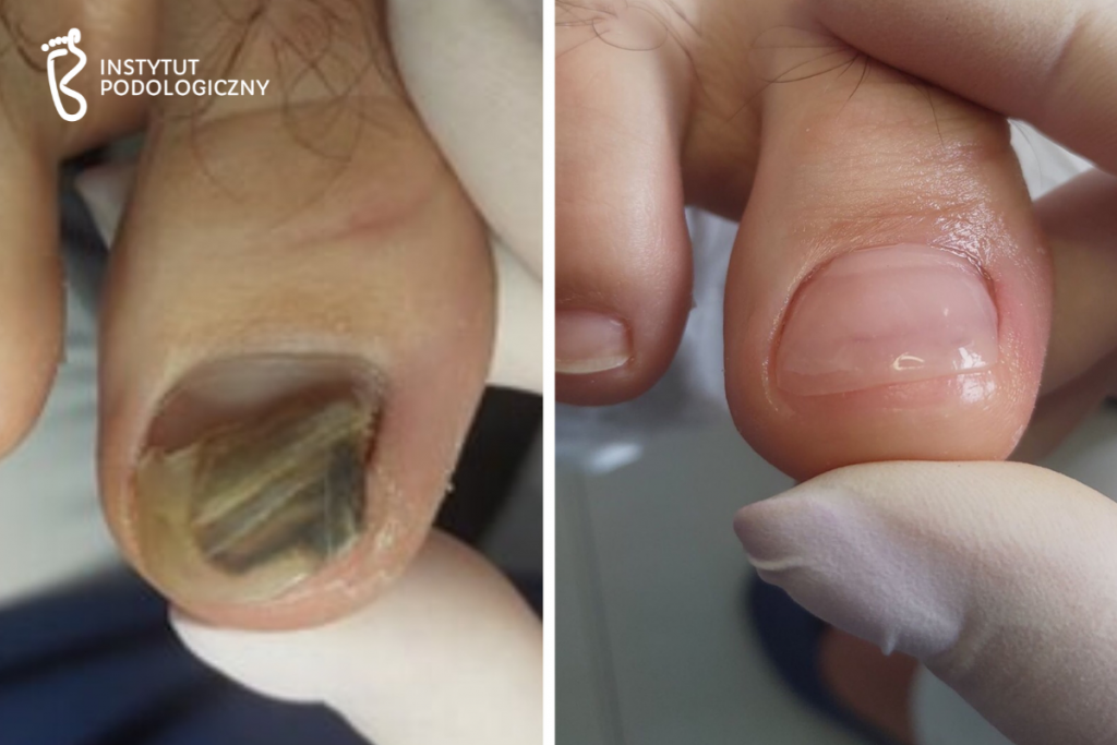 Protetyka paznokci
